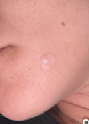 Parches invisibles para Acne Pimple Patch 24 pzas.